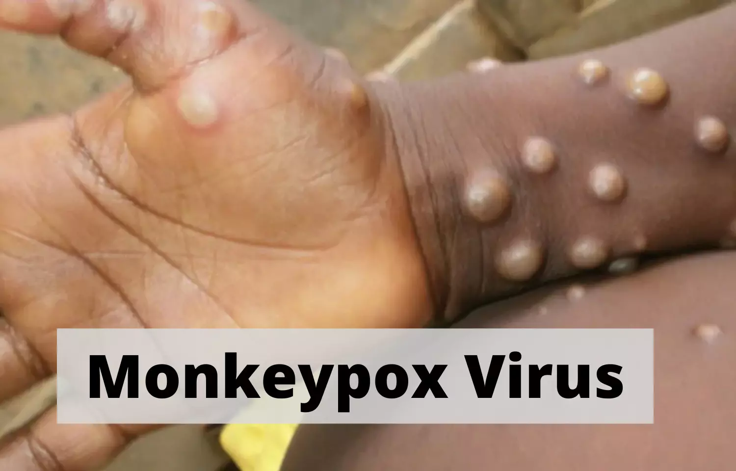 Monkeypox